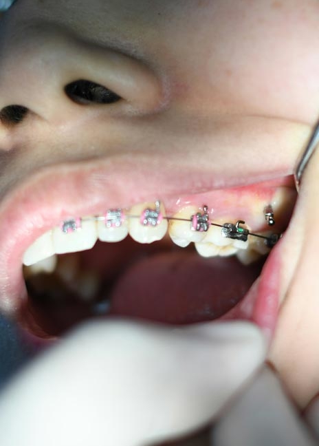Manningtree Dental - Fixed Braces