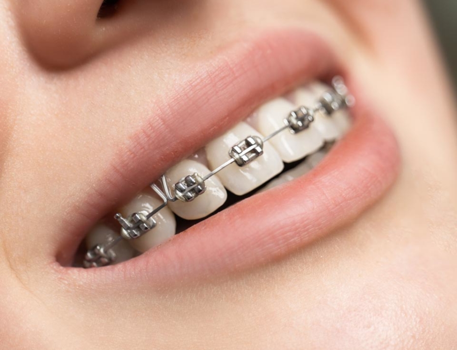 Manningtree Dental - Fixed Braces