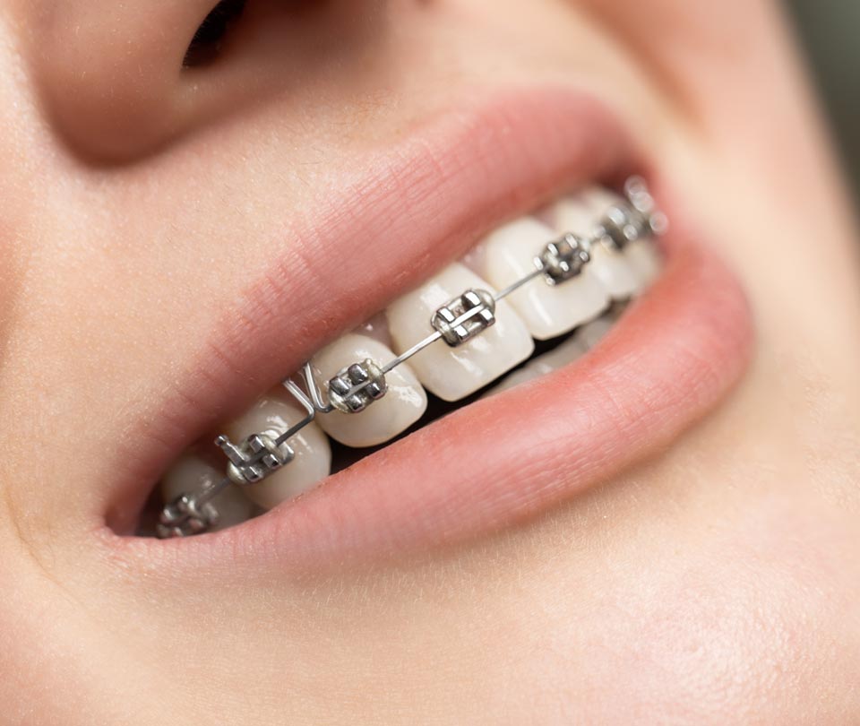 Manningtree Dental - Fixed Braces