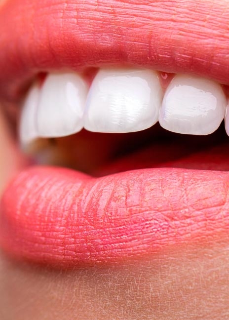 Manningtree Dental - Porcelain Veneers
