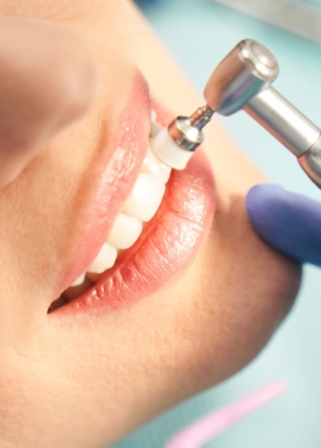 Manningtree Dental - Scale & Polish