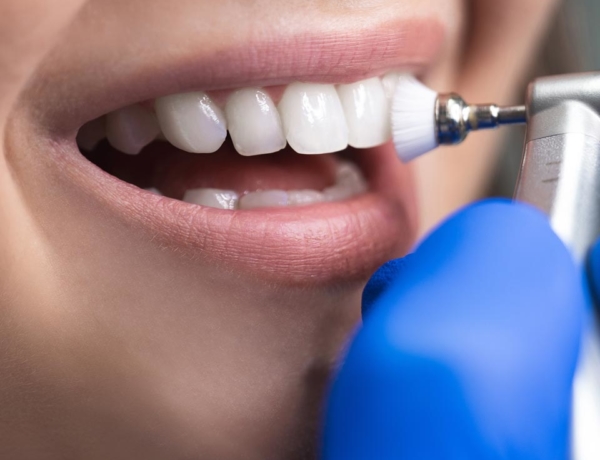 Manningtree Dental - Stain removal