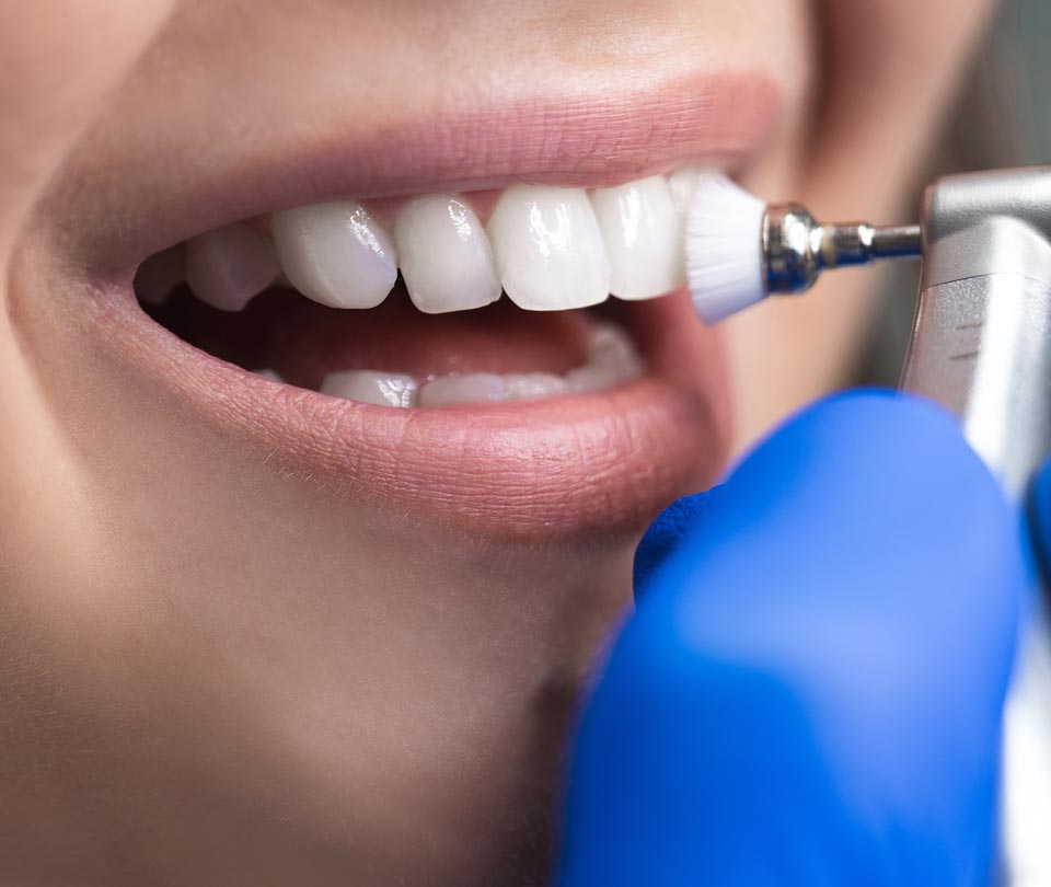 Manningtree Dental - Stain removal