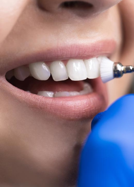 Manningtree Dental - Stain removal