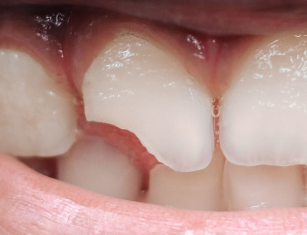 Broken Teeth - Manningtree Dental