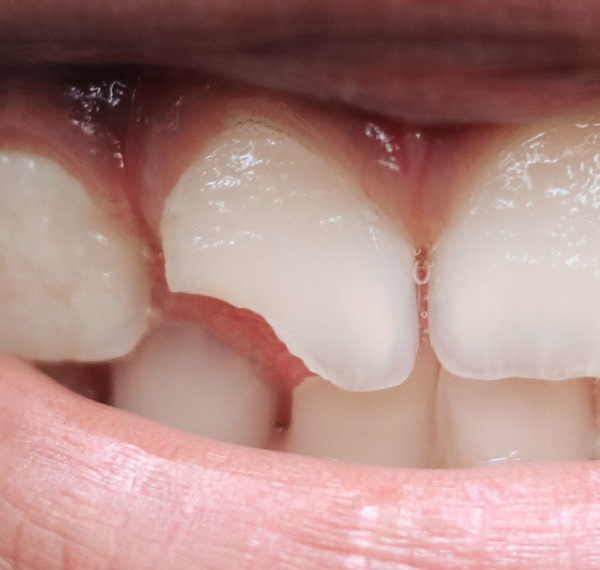 Broken Teeth - Manningtree Dental