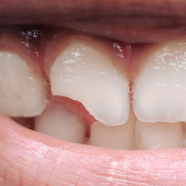 Broken Teeth - Manningtree Dental