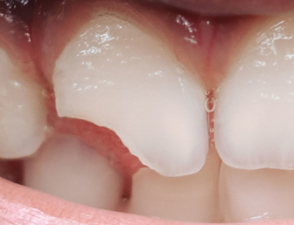 Broken Teeth - Manningtree Dental
