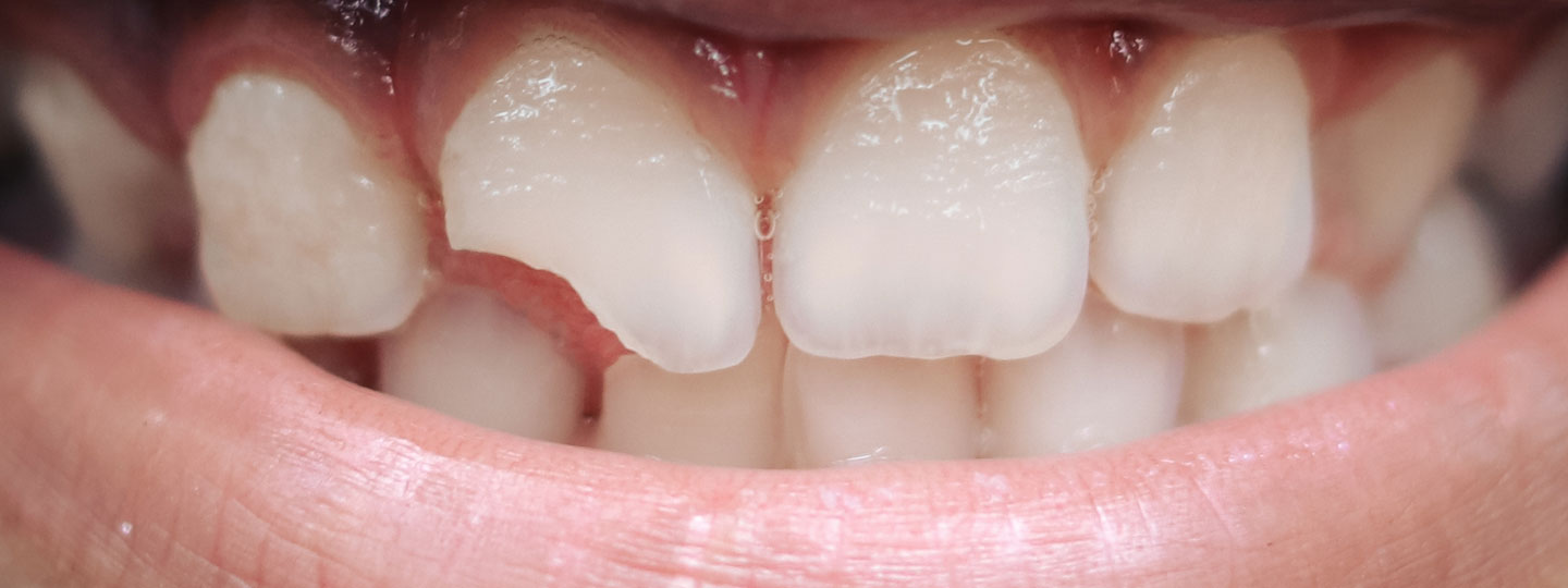 Broken Teeth - Manningtree Dental
