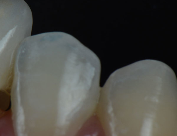 Crowded Teeth - Manningtree Dental