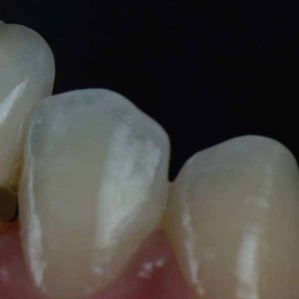 Crowded Teeth - Manningtree Dental