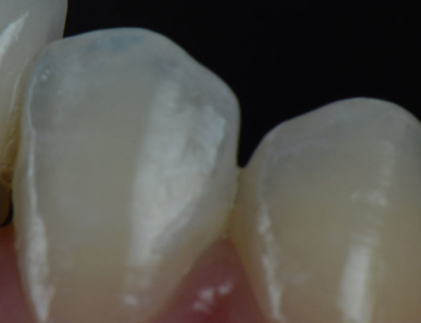 Crowded Teeth - Manningtree Dental