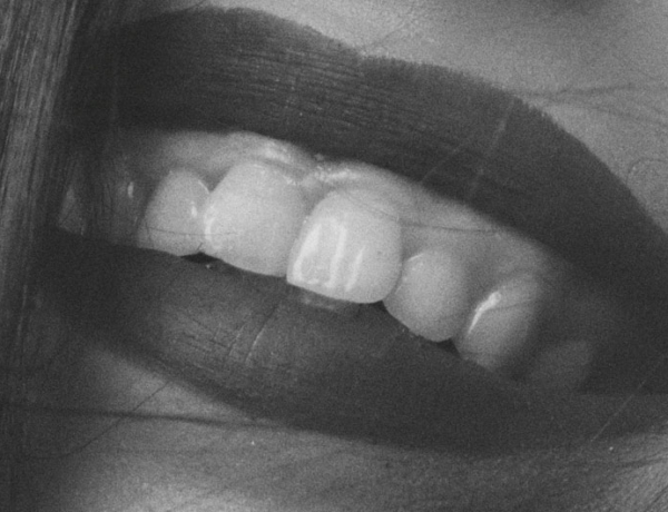 Gummy Smile - Manningtree Dental