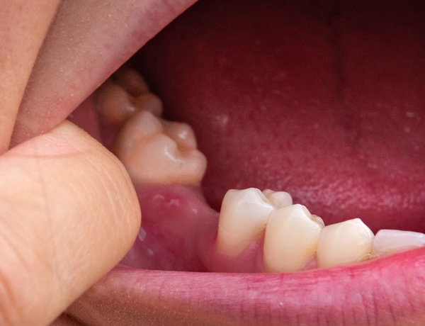 Missing Teeth - Manningtree Dental