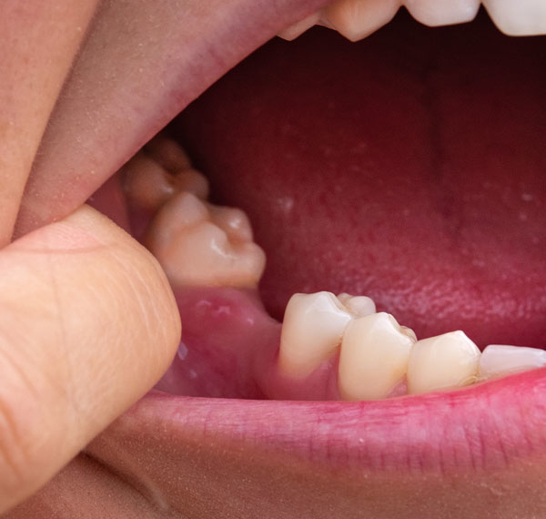 Missing Teeth - Manningtree Dental