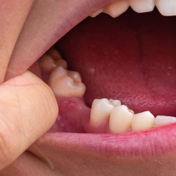 Missing Teeth - Manningtree Dental