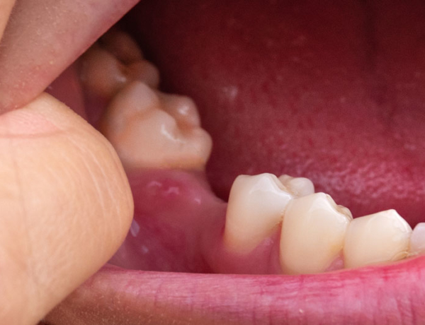 Missing Teeth - Manningtree Dental