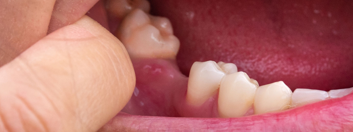 Missing Teeth - Manningtree Dental