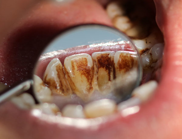 Stained Teeth - Manningtree Dental