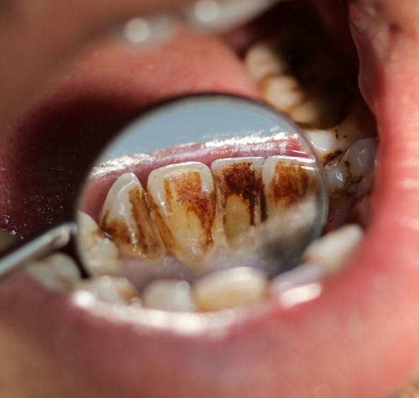 Stained Teeth - Manningtree Dental