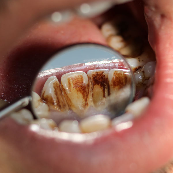 Stained Teeth - Manningtree Dental