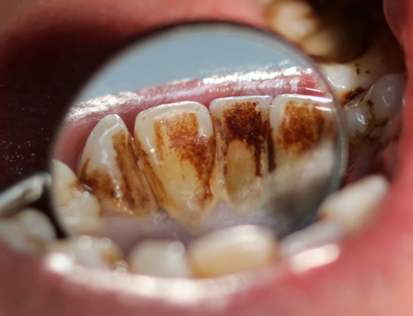 Stained Teeth - Manningtree Dental