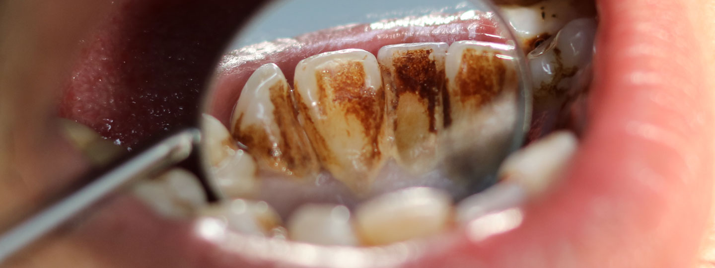 Stained Teeth - Manningtree Dental