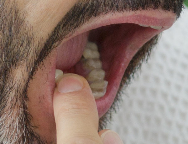 Wobbly Teeth - Manningtree Dental