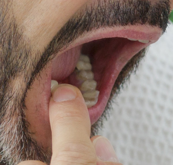 Wobbly Teeth - Manningtree Dental