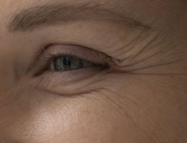 Wrinkles & Fine Lines - Manningtree Dental