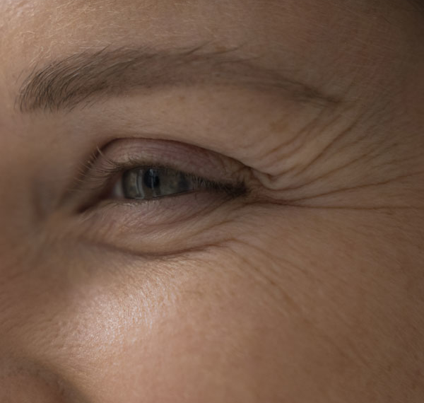 Wrinkles & Fine Lines - Manningtree Dental