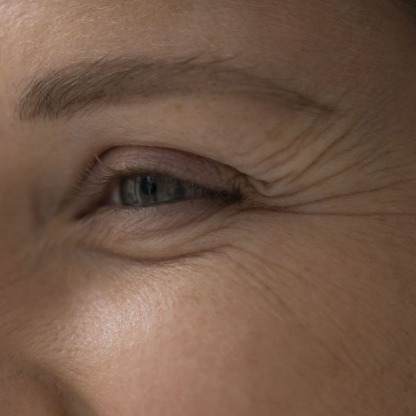 Wrinkles & Fine Lines - Manningtree Dental