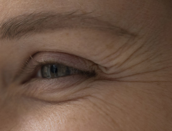 Wrinkles & Fine Lines - Manningtree Dental