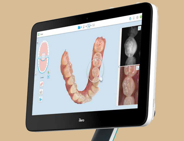 Digital intra oral Scanner - Manningtree Dental